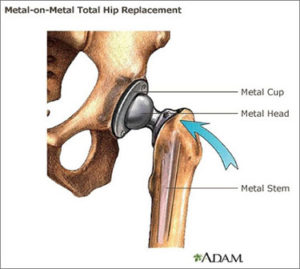 What Are Metal on Metal Hip Implants