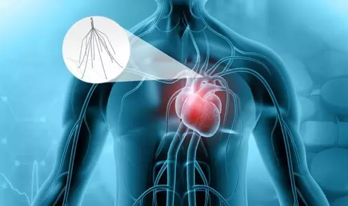IVC-Filter.jpg