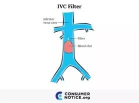 What-Is-An-IVC-Filter.jpg